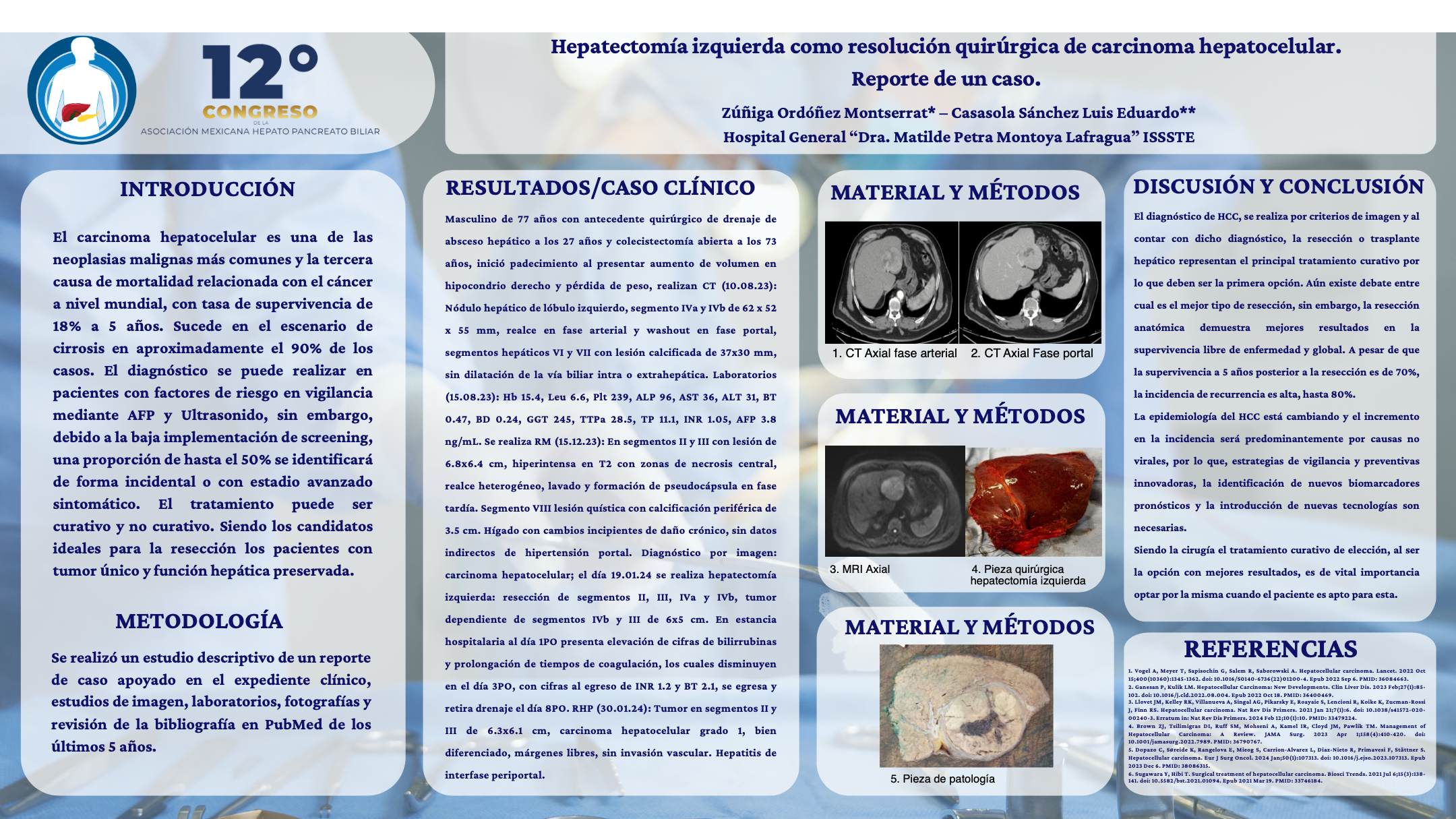 Póster de Hepatectomía izquierda como resolución quirúrgica de carcinoma hepatocelular. Reporte de un caso.