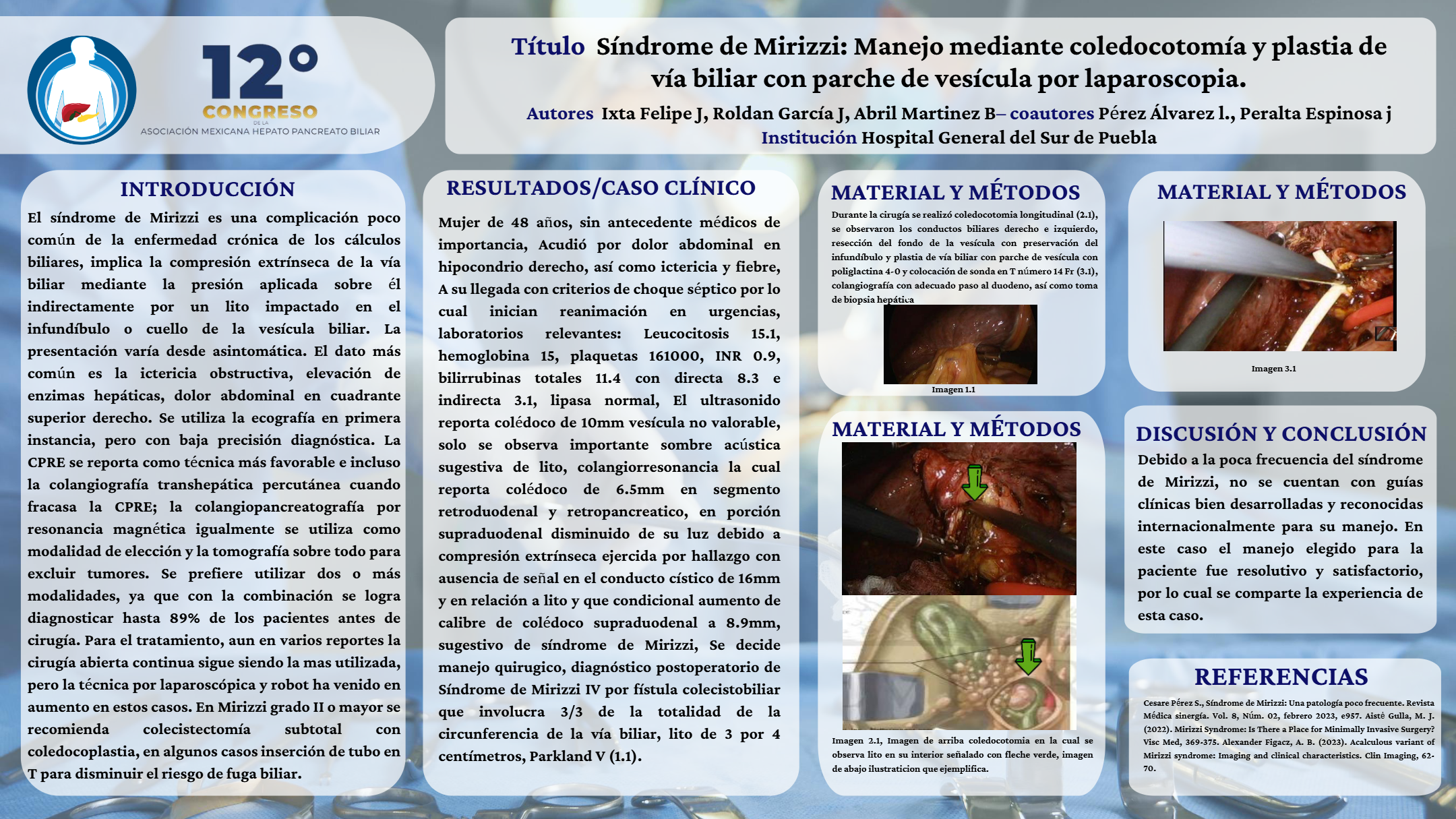 Póster de Síndrome de Mirizzi: manejo mediante coledocotomía y plastia de vía biliar con parche de vesícula por laparoscopía.