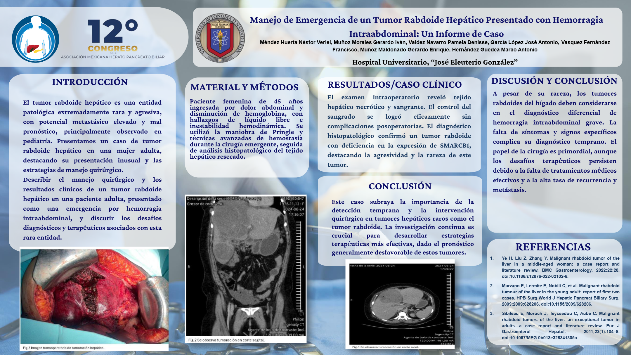 Póster de Manejo de emergencia de un tumor rabdoide hepático presentado con hemorragia intraabdominal: un informe de caso.