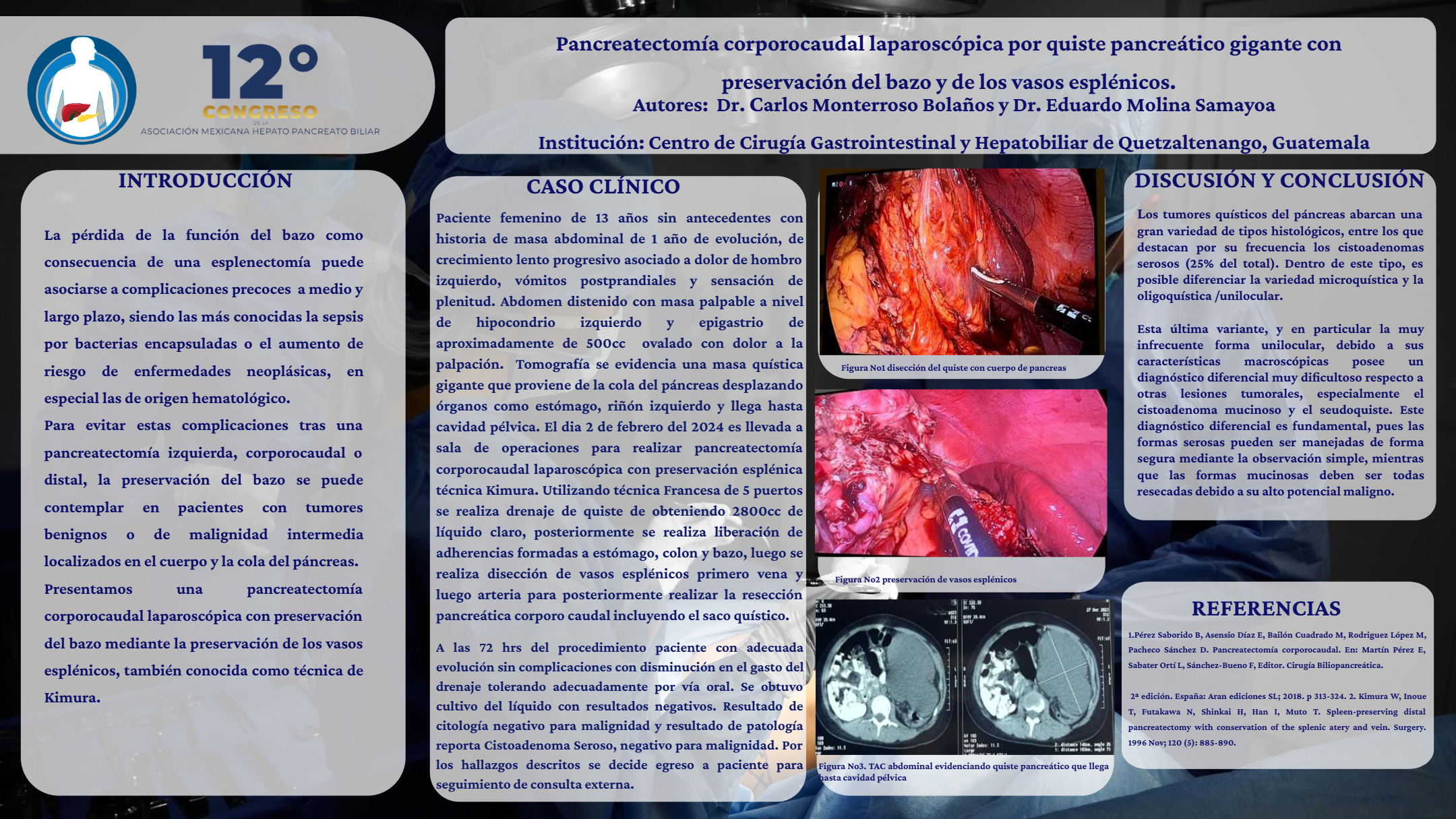 Póster de Pancreatectomía corporocaudal laparoscópica por quiste pancreático gigante con preservación del bazo y de los vasos esplénicos.