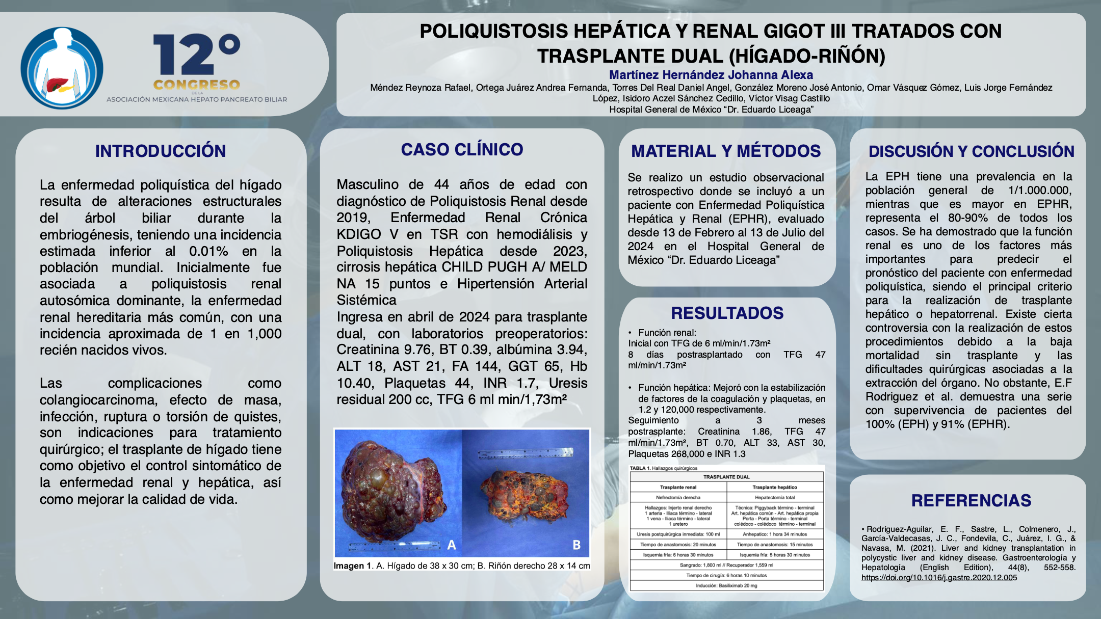Póster de Poliquistosis hepática y renal GIGOT III tratados con trasplante dual (hígado-riñón).