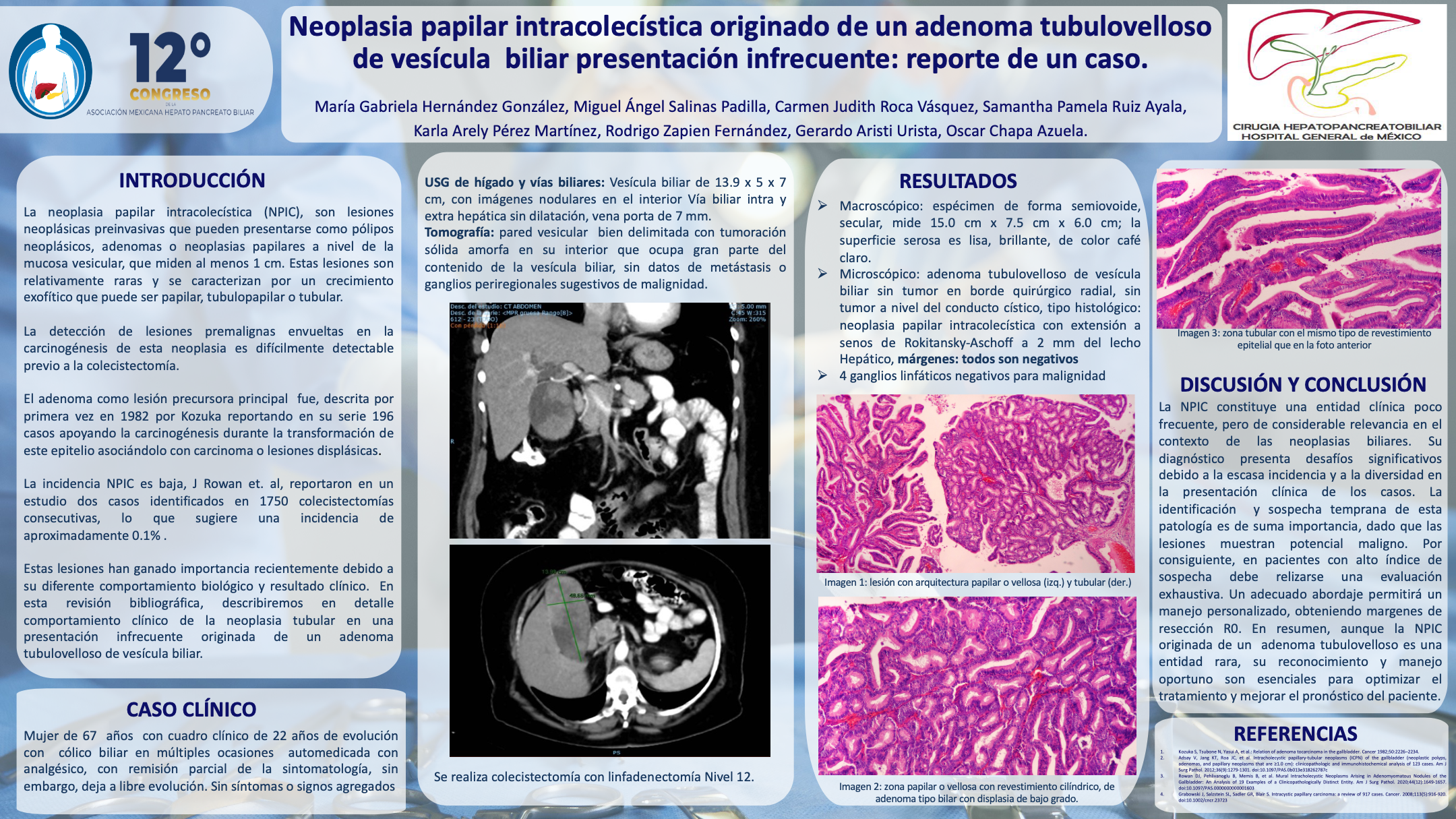 Póster de Neoplasia papilar intracolecistica con adenoma tubulovelloso de vesícula biliar presentación infrecuente: reporte de un caso.